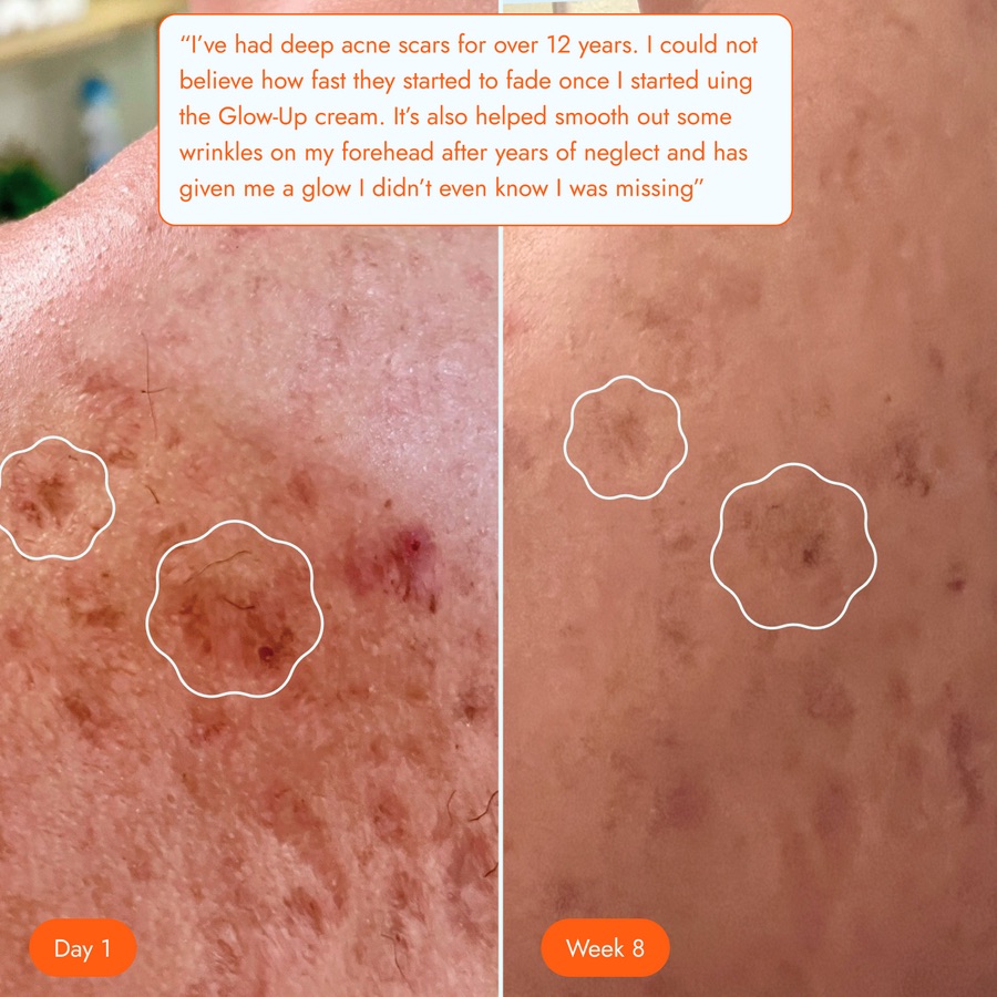 A customer review with before and after photos of acne scars, day 1 and week 8